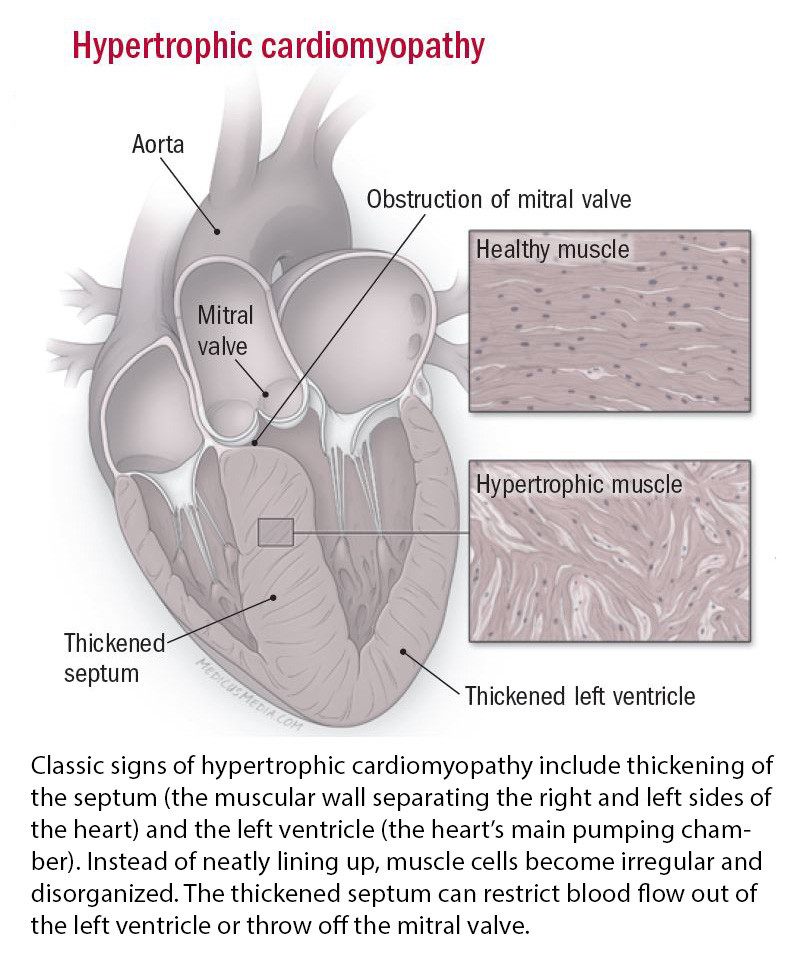 Cardiomyopathy: Symptoms & Treatment