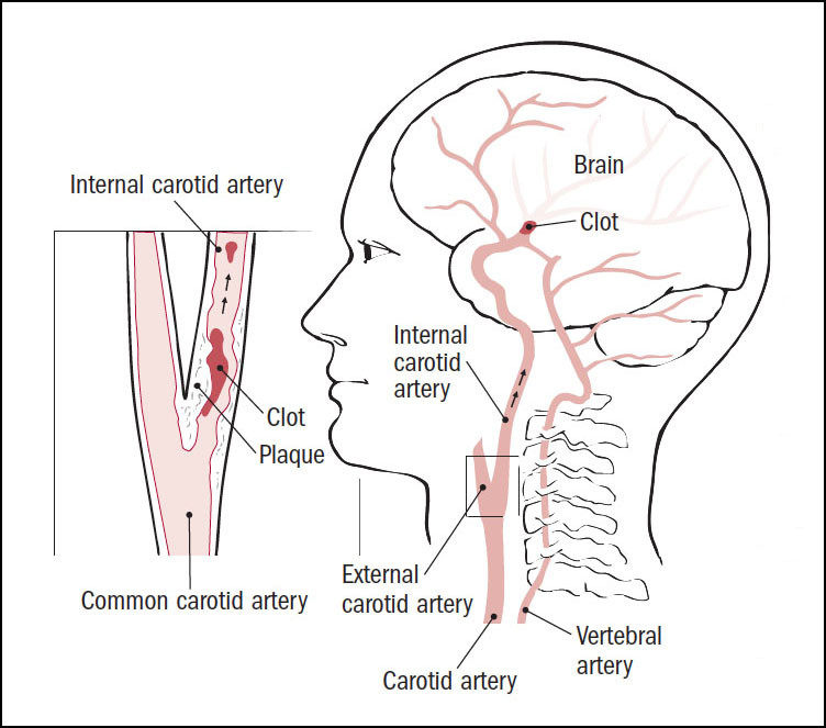 pressure on carotid artery