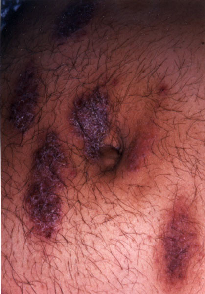 Photograph of atopic dermatitis and eczema