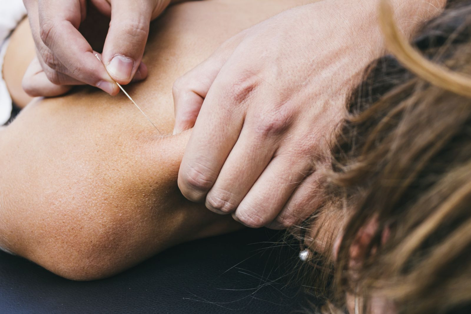 Can Acupuncture Help Treat Back Pain?