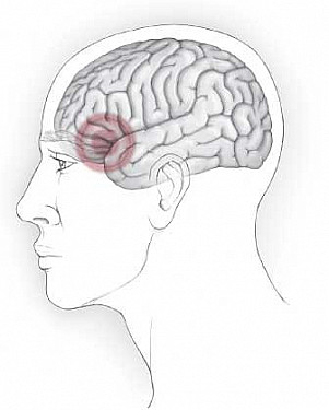 migraine headache diagram