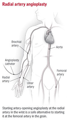 From the wrist to the heart: new angioplasty method is safe, effective