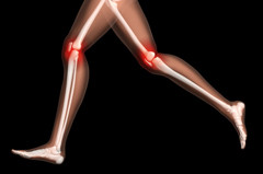 Taking the pain out of runner’s knee