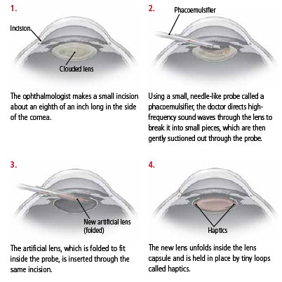 Cataract-surgery.jpg