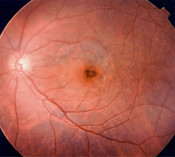 Macular-degneration