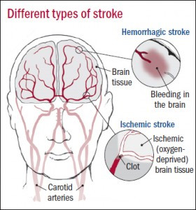 Types of stroke