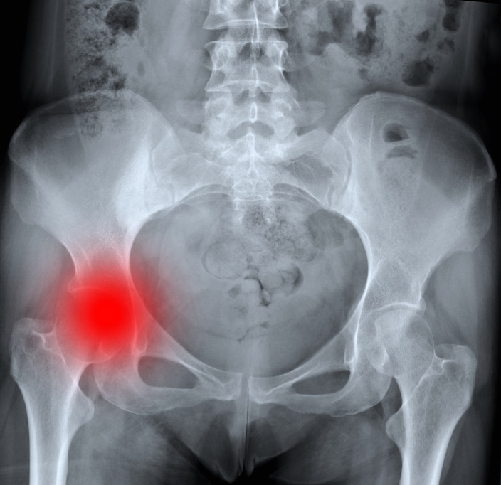 Painful / Worn Hip replacement — Gormack Orthopaedics