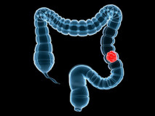 Decline in colorectal cancer in U.S. tied to wider use of testing featured image