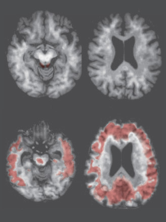 Brain age' screening for dementia