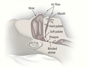 Illustration of obstructive sleep apnea