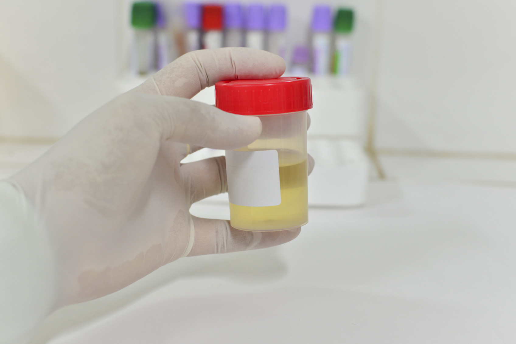 New urine test predicts high-grade prostate cancer