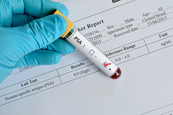 New study once again casts doubt on PSA screening featured image