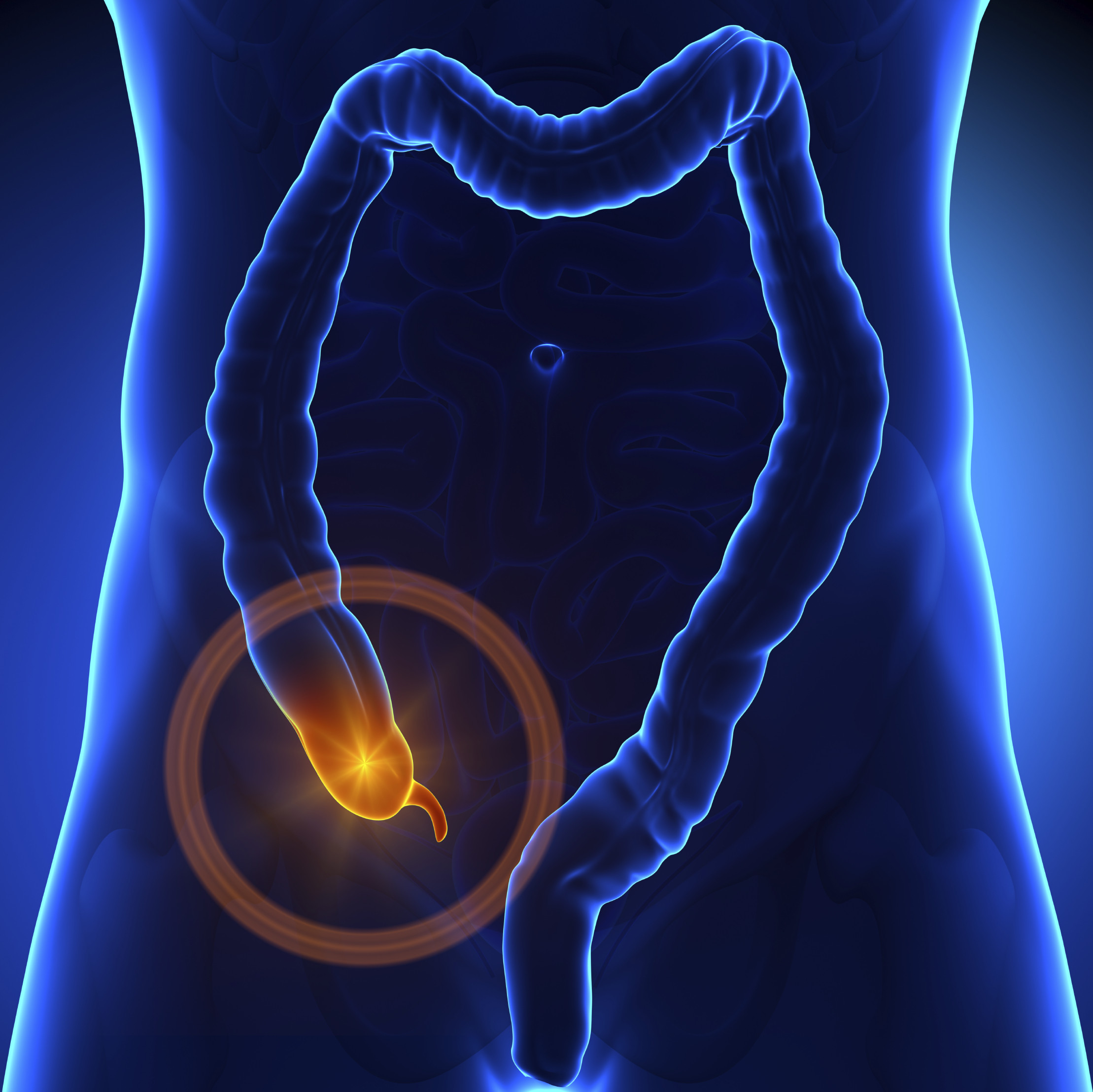 appendix-appendicitis