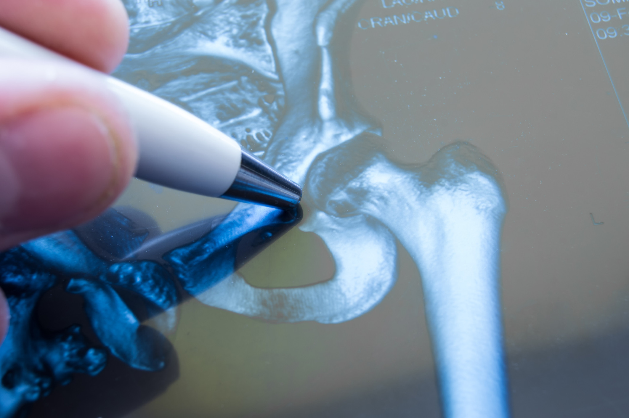 Hip and Knee Joint Replacement Surgery: How Is It Done?